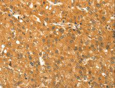 TM7SF2 Antibody - Immunohistochemistry of paraffin-embedded Human liver cancer using TM7SF2 Polyclonal Antibody at dilution of 1:30.