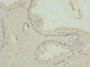 TM9SF1 Antibody - Immunohistochemistry of paraffin-embedded human prostate cancer at dilution 1:100