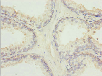 TM9SF1 Antibody - Immunohistochemistry of paraffin-embedded human prostate cancer at dilution 1:100