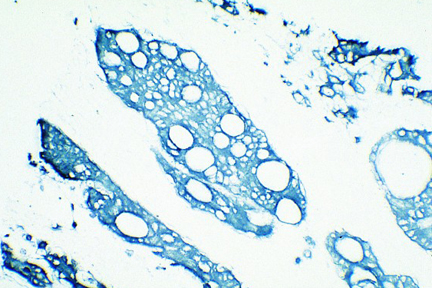 Product - Tumor: Cytokeratin (s), VECTASTAIN® Elite® ABC Kit, TMB (blue).