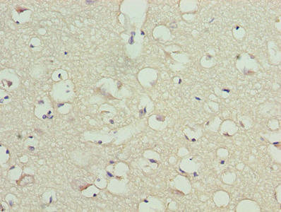 TMCC1 Antibody - Immunohistochemistry of paraffin-embedded human colon cancer using TMCC1 Antibody at dilution of 1:100