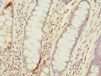 TMED10 / TMP21 Antibody - Immunohistochemistry of paraffin-embedded human colon cancer at dilution 1:100
