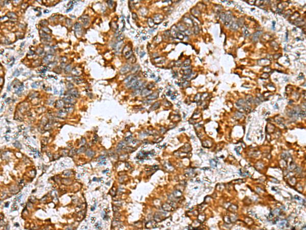 TMED10 / TMP21 Antibody - Immunohistochemistry of paraffin-embedded Human lung cancer tissue  using TMED10 Polyclonal Antibody at dilution of 1:65(×200)