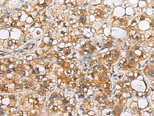 TMED10 / TMP21 Antibody - Immunohistochemistry of paraffin-embedded Human liver cancer tissue  using TMED10 Polyclonal Antibody at dilution of 1:65(×200)