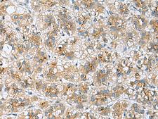TMED10 / TMP21 Antibody - Immunohistochemistry of paraffin-embedded Human liver cancer tissue  using TMED10 Polyclonal Antibody at dilution of 1:50(×200)