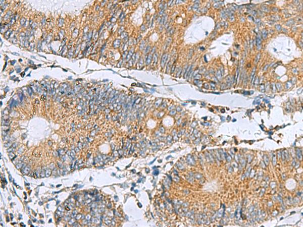 TMED10 / TMP21 Antibody - Immunohistochemistry of paraffin-embedded Human colorectal cancer tissue  using TMED10 Polyclonal Antibody at dilution of 1:50(×200)