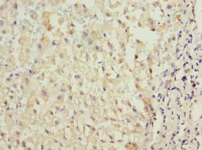 TMED2 Antibody - Immunohistochemistry of paraffin-embedded human liver cancer using antibody at dilution of 1:100.