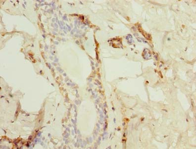 TMED2 Antibody - Immunohistochemistry of paraffin-embedded human breast cancer using antibody at dilution of 1:100.