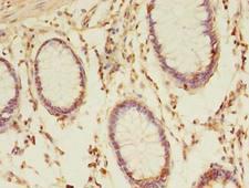 TMED3 Antibody - Immunohistochemistry of paraffin-embedded human colon cancer using antibody at dilution of 1:100.