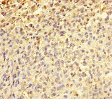 TMEFF2 Antibody - Immunohistochemistry of paraffin-embedded human melanoma cancer at dilution of 1:100