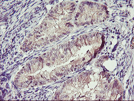 TMEFF2 Antibody - IHC of paraffin-embedded Adenocarcinoma of Human endometrium tissue using anti-TMEFF2 mouse monoclonal antibody.