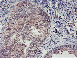 TMEFF2 Antibody - IHC of paraffin-embedded Adenocarcinoma of Human endometrium tissue using anti-TMEFF2 mouse monoclonal antibody. (Heat-induced epitope retrieval by 10mM citric buffer, pH6.0, 100C for 10min).