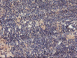 TMEFF2 Antibody - IHC of paraffin-embedded Human lymphoma tissue using anti-TMEFF2 mouse monoclonal antibody. (Heat-induced epitope retrieval by 10mM citric buffer, pH6.0, 100C for 10min).