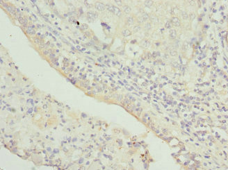 TMEM1 / TRAPPC10 Antibody - Immunohistochemistry of paraffin-embedded human lung cancer at dilution 1:100
