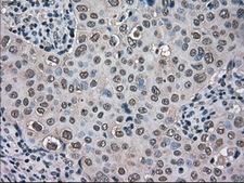 TMEM100 Antibody - IHC of paraffin-embedded Adenocarcinoma of breast tissue using anti-TMEM100 mouse monoclonal antibody. (Dilution 1:50).
