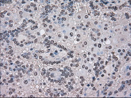TMEM100 Antibody - IHC of paraffin-embedded Carcinoma of kidney tissue using anti-TMEM100 mouse monoclonal antibody. (Dilution 1:50).