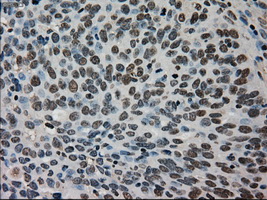 TMEM100 Antibody - IHC of paraffin-embedded Adenocarcinoma of ovary tissue using anti-TMEM100 mouse monoclonal antibody. (Dilution 1:50).