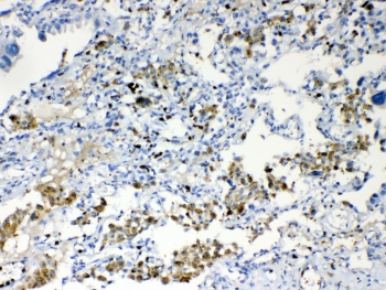 TMEM107 Antibody - IHC testing of FFPE human lung cancer tissue with TMEM107 antibody at 1ug/ml. Required HIER: steam section in pH6 citrate buffer for 20 min and allow to cool prior to testing.