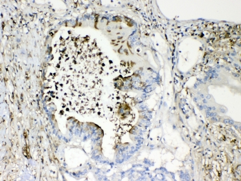TMEM107 Antibody - IHC testing of FFPE human intestinal cancer tissue with TMEM107 antibody at 1ug/ml. Required HIER: steam section in pH6 citrate buffer for 20 min and allow to cool prior to testing.