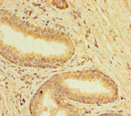 TMEM120B Antibody - Immunohistochemistry of paraffin-embedded human prostate cancer using TMEM120B Antibody at dilution of 1:100