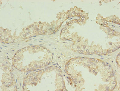 TMEM141 Antibody - Immunohistochemistry of paraffin-embedded human prostate cancer using TMEM141 Antibody at dilution of 1:100