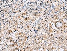 TMEM141 Antibody - Immunohistochemistry of paraffin-embedded Human cervical cancer tissue  using TMEM141 Polyclonal Antibody at dilution of 1:60(×200)