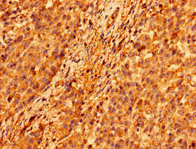 TMEM142A / ORAI1 Antibody - Immunohistochemistry image of paraffin-embedded human colon cancer at a dilution of 1:100