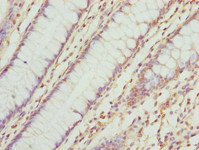TMEM143 Antibody - Immunohistochemistry of paraffin-embedded human colon cancer using TMEM143 Antibody at dilution of 1:100