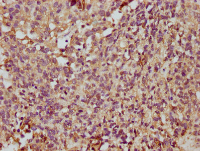 TMEM14A Antibody - IHC image of TMEM14A Antibody diluted at 1:350 and staining in paraffin-embedded human ovarian cancer performed on a Leica BondTM system. After dewaxing and hydration, antigen retrieval was mediated by high pressure in a citrate buffer (pH 6.0). Section was blocked with 10% normal goat serum 30min at RT. Then primary antibody (1% BSA) was incubated at 4°C overnight. The primary is detected by a biotinylated secondary antibody and visualized using an HRP conjugated SP system.