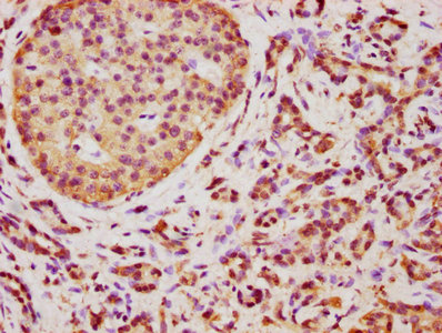 TMEM14A Antibody - IHC image of TMEM14A Antibody diluted at 1:350 and staining in paraffin-embedded human pancreatic cancer performed on a Leica BondTM system. After dewaxing and hydration, antigen retrieval was mediated by high pressure in a citrate buffer (pH 6.0). Section was blocked with 10% normal goat serum 30min at RT. Then primary antibody (1% BSA) was incubated at 4°C overnight. The primary is detected by a biotinylated secondary antibody and visualized using an HRP conjugated SP system.
