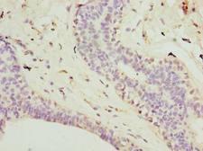 TMEM161A Antibody - Immunohistochemistry of paraffin-embedded human breast cancer using antibody at dilution of 1:100.