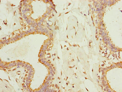 TMEM161A Antibody - IHC image of TMEM161A Antibody diluted at 1:500 and staining in paraffin-embedded human endometrial cancer performed on a Leica BondTM system. After dewaxing and hydration, antigen retrieval was mediated by high pressure in a citrate buffer (pH 6.0). Section was blocked with 10% normal goat serum 30min at RT. Then primary antibody (1% BSA) was incubated at 4°C overnight. The primary is detected by a biotinylated secondary antibody and visualized using an HRP conjugated SP system.