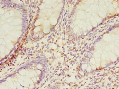 TMEM165 Antibody - Immunohistochemistry of paraffin-embedded human colon cancer using antibody at dilution of 1:100.