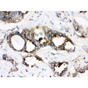 TMEM173 / STING Antibody - TMEM173 antibody IHC-paraffin. IHC(P): Human Lung Cancer Tissue.