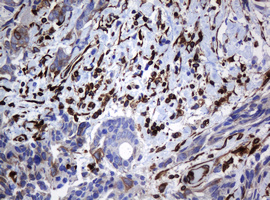 TMEM173 / STING Antibody - IHC of paraffin-embedded Adenocarcinoma of Human breast tissue using anti-TMEM173 mouse monoclonal antibody. (Heat-induced epitope retrieval by 10mM citric buffer, pH6.0, 120°C for 3min).