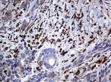 TMEM173 / STING Antibody - IHC of paraffin-embedded Adenocarcinoma of Human breast tissue using anti-TMEM173 mouse monoclonal antibody. (Heat-induced epitope retrieval by 10mM citric buffer, pH6.0, 120°C for 3min).