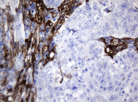TMEM173 / STING Antibody - IHC of paraffin-embedded Adenocarcinoma of Human colon tissue using anti-TMEM173 mouse monoclonal antibody. (Heat-induced epitope retrieval by 10mM citric buffer, pH6.0, 120°C for 3min).