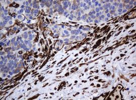 TMEM173 / STING Antibody - IHC of paraffin-embedded Carcinoma of Human lung tissue using anti-TMEM173 mouse monoclonal antibody. (Heat-induced epitope retrieval by 10mM citric buffer, pH6.0, 120°C for 3min).
