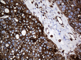 TMEM173 / STING Antibody - IHC of paraffin-embedded Adenocarcinoma of Human ovary tissue using anti-TMEM173 mouse monoclonal antibody. (Heat-induced epitope retrieval by 10mM citric buffer, pH6.0, 120°C for 3min).