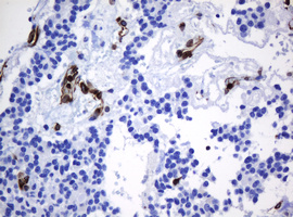 TMEM173 / STING Antibody - IHC of paraffin-embedded Carcinoma of Human pancreas tissue using anti-TMEM173 mouse monoclonal antibody. (Heat-induced epitope retrieval by 10mM citric buffer, pH6.0, 120°C for 3min).