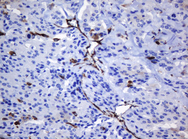 TMEM173 / STING Antibody - IHC of paraffin-embedded Carcinoma of Human thyroid tissue using anti-TMEM173 mouse monoclonal antibody. (Heat-induced epitope retrieval by 10mM citric buffer, pH6.0, 120°C for 3min).