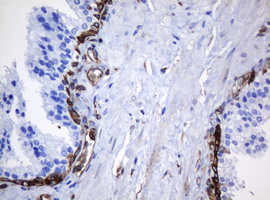 TMEM173 / STING Antibody - IHC of paraffin-embedded Carcinoma of Human prostate tissue using anti-TMEM173 mouse monoclonal antibody. (Heat-induced epitope retrieval by 10mM citric buffer, pH6.0, 120°C for 3min).