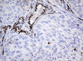 TMEM173 / STING Antibody - IHC of paraffin-embedded Carcinoma of Human bladder tissue using anti-TMEM173 mouse monoclonal antibody. (Heat-induced epitope retrieval by 10mM citric buffer, pH6.0, 120°C for 3min).