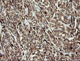 TMEM173 / STING Antibody - IHC of paraffin-embedded Carcinoma of Human thyroid tissue using anti-TMEM173 mouse monoclonal antibody.