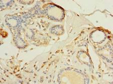 TMEM176B / LR8 Antibody - Immunohistochemistry of paraffin-embedded human breast cancer using antibody at dilution of 1:100.