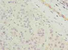 TMEM177 Antibody - Immunohistochemistry of paraffin-embedded human liver cancer using antibody at dilution of 1:100.