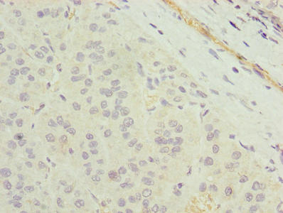 TMEM177 Antibody - Immunohistochemistry of paraffin-embedded human liver cancer using TMEM177 Antibody at dilution of 1:100