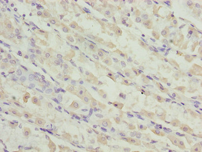 TMEM19 Antibody - Immunohistochemistry of paraffin-embedded human gastric cancer using TMEM19 Antibody at dilution of 1:100