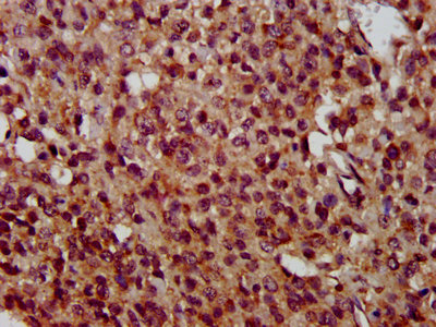 TMEM192 Antibody - IHC image of TMEM192 Antibody diluted at 1:400 and staining in paraffin-embedded human glioma performed on a Leica BondTM system. After dewaxing and hydration, antigen retrieval was mediated by high pressure in a citrate buffer (pH 6.0). Section was blocked with 10% normal goat serum 30min at RT. Then primary antibody (1% BSA) was incubated at 4°C overnight. The primary is detected by a biotinylated secondary antibody and visualized using an HRP conjugated SP system.