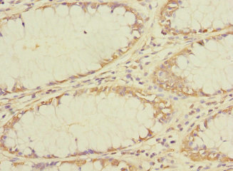 TMEM209 Antibody - Immunohistochemistry of paraffin-embedded human colon cancer using TMEM209 Antibody at dilution of 1:100